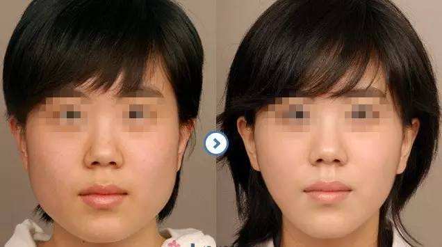 截骨手术多久可以走路 截骨手术多久可以走路