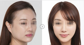 做削骨手术需要多少钱