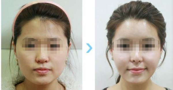 削骨后脸下垂图片