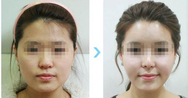 削骨后脸下垂图片 削骨后脸下垂图片