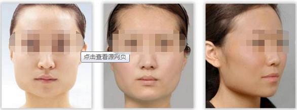 削骨的恢复期很痛苦吗 削骨的恢复期很痛苦吗