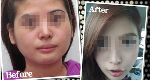 削骨后老了会怎样 削骨后老了会怎样