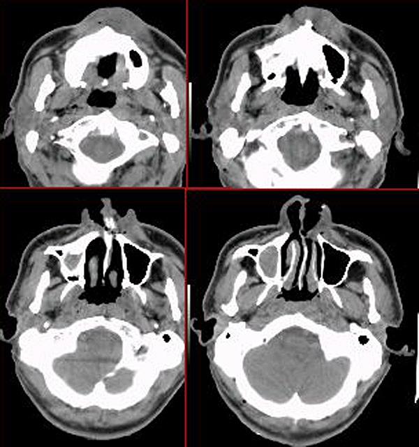 上颌窦囊肿手术费用 上颌窦囊肿手术费用
