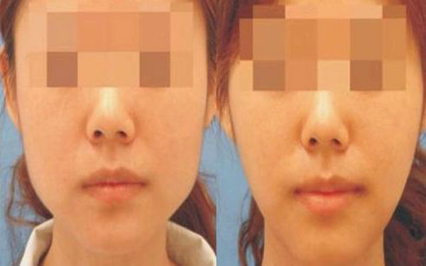 磨下颚骨恢复期多久? 磨下颚骨恢复期多久?