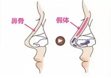 鼻根歪了可以手术矫正吗
