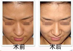 鼻梁歪曲矫正 鼻梁歪曲矫正