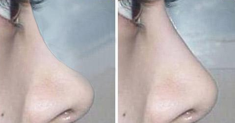 驼峰鼻矫正恢复图 驼峰鼻矫正恢复图