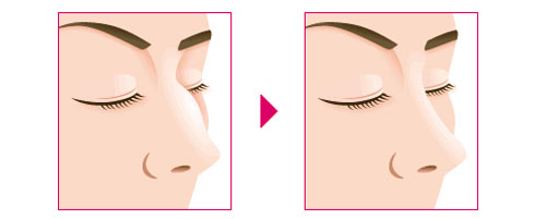 天津驼峰鼻矫正哪里做的好 天津驼峰鼻矫正哪里做的好