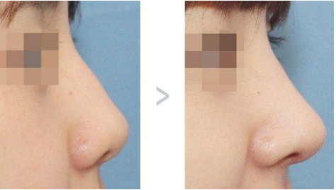 佛山做驼峰鼻矫正的哪里做的好 佛山做驼峰鼻矫正的哪里做的好