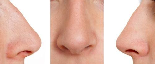 南京的驼峰鼻矫正安全吗 南京的驼峰鼻矫正安全吗