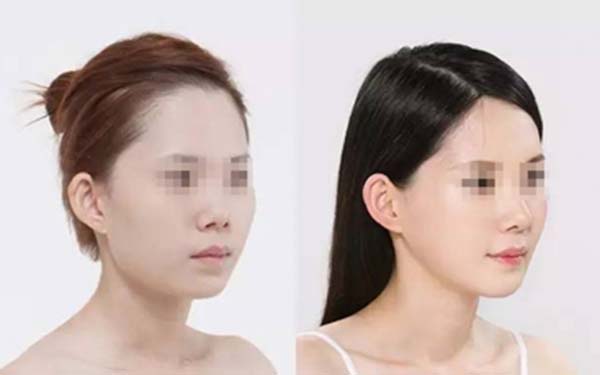  ���ձǽ�����Σ��ô