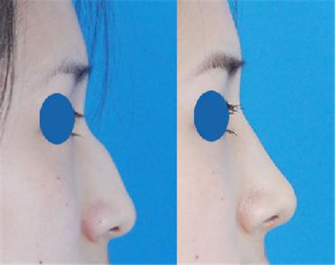 驼峰鼻矫正要多少钱? 驼峰鼻矫正要多少钱?