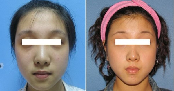 ��ͷ��С�ָ�Ч��