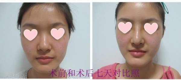 ����ͷ��С����ʱҪע�������