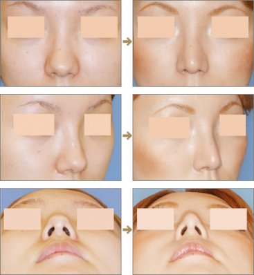 ��ͷ��С���ָ�����