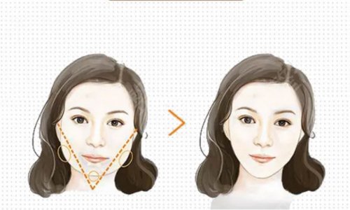 北京协和医院整形科吸脂技术如何