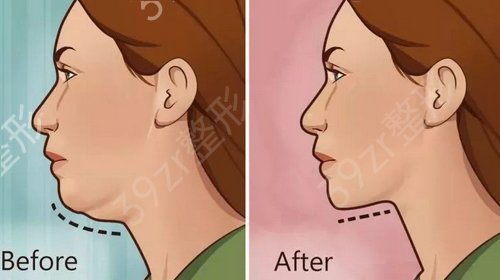 北京协和医院整形科吸脂技术如何