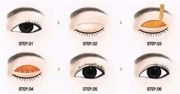 贵阳整形医院双眼皮排名榜权威发布