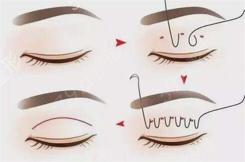 广东顺德做双眼皮哪个医院好