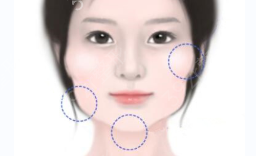 杭州颧骨内推整形医院排行榜公布