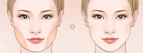 南方医科大学南方医院让我摆脱了大胖脸成为小V脸呢