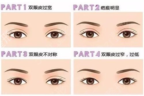 国内双眼皮修复专家排名