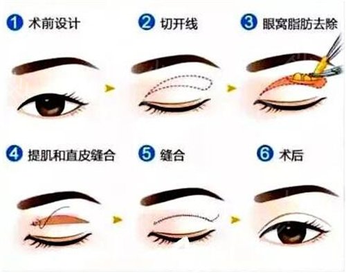 德阳人民医院双眼皮果*好