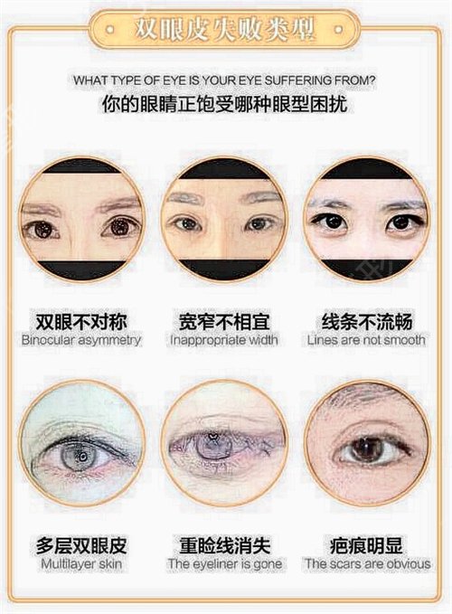 在李芳整形做了眼部修复手术