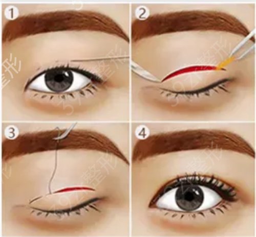 郑州屈小丽做双眼皮三个月