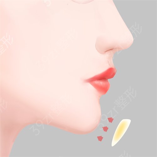 郑州东方整形美容医院假体植入垫下巴让我收获了娇俏阔爱的下巴