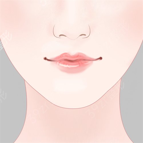 郑州东方整形美容医院假体植入垫下巴让我收获了娇俏阔爱的下巴