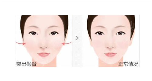 在韩国原辰整形做的改脸型