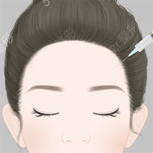 华人整形做了丰太阳穴后