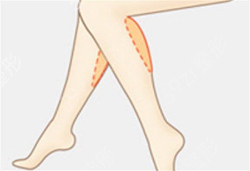 济南美莲整形美容医院做了吸脂瘦大腿