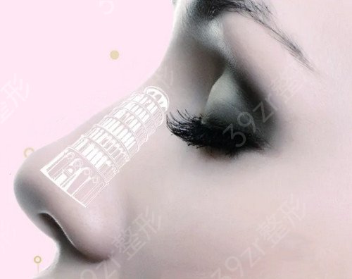 衡阳曹家做的膨体隆鼻两个月就看起来*自然呢