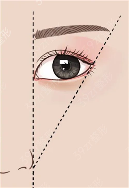 广州紫馨体验了一把双眼皮