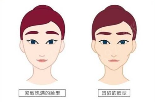 奇致整形美容医院全脸填充恢复两个月果图分享