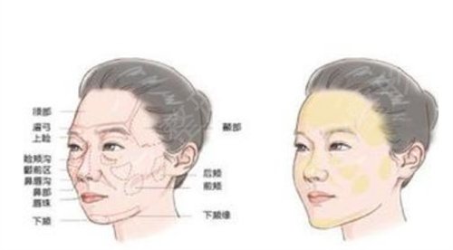 奇致整形美容医院全脸填充恢复两个月果图分享