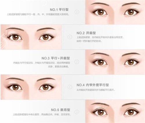 青岛博士整形医院做双眼皮恢复两个月后变成了这样…