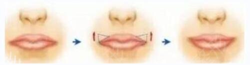 青岛唇部整形医院排行榜前三强揭晓了