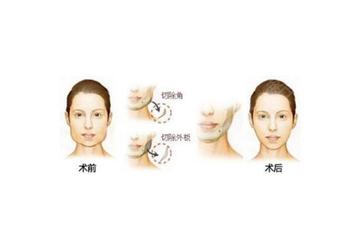 2022全国磨骨三甲医院有哪些