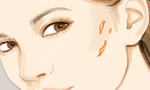 广州去疤哪个医生厉害