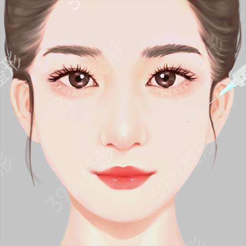 在长沙三和整形医院做了脂肪丰额头后