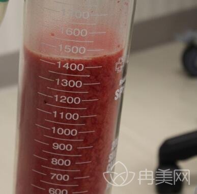 到卓艺整形做了360溶脂减肥