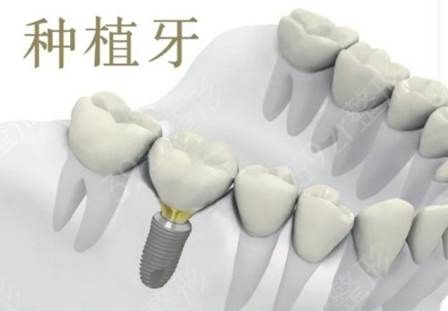 上海种植牙医生排行前三名单发布