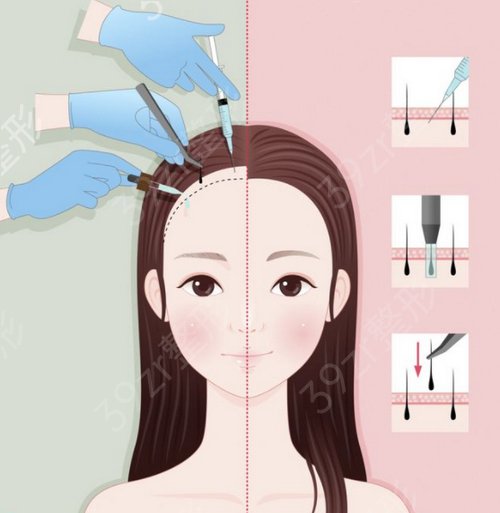 植发医院哪家医院技术好