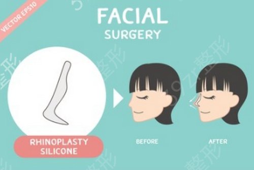 上海隆鼻修复医院哪家好