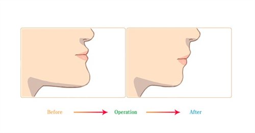 陕西友谊医院整形科卢丙仑下颌角怎么样