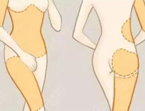 杭州哪家医院做大腿吸脂好