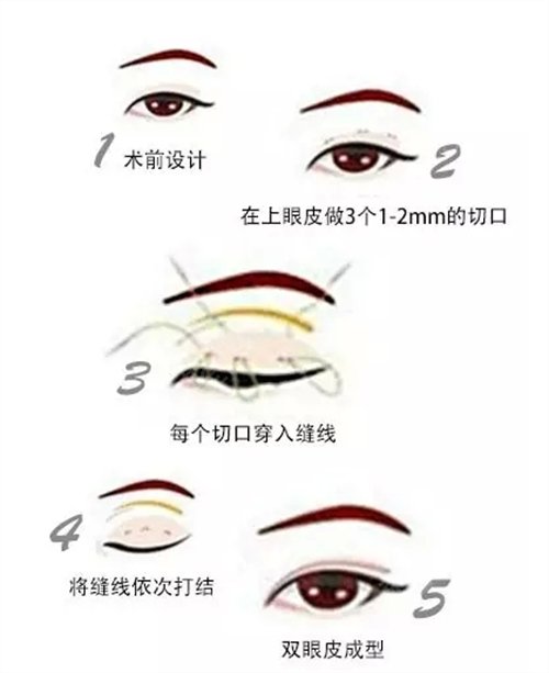 合肥天鹅湖整形价目表更新版本来了